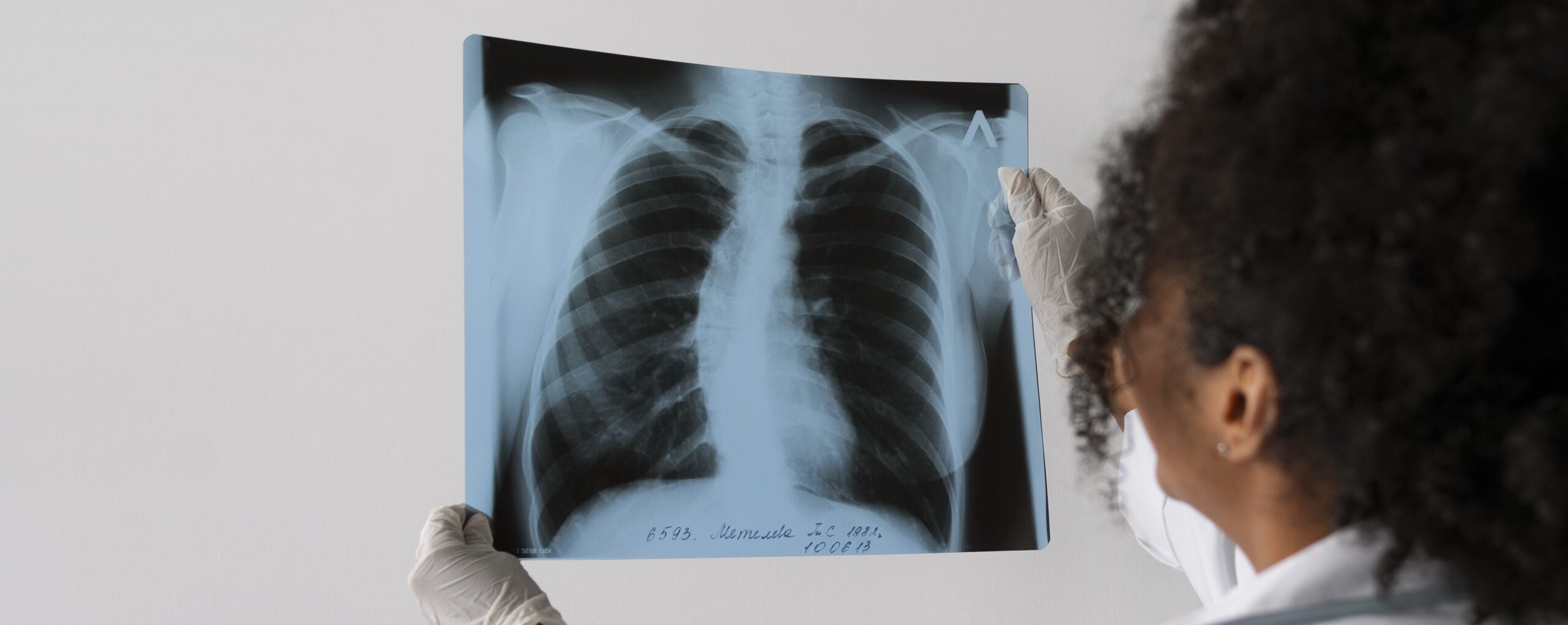 ИИ научился определять возраст человека по рентгену груди